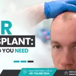 Hair Transplant: Everything You Need To Know