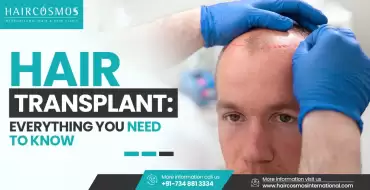 Hair Transplant: Everything You Need To Know